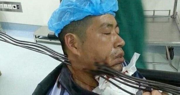 Boğazına altı demir çubuk saplandı!