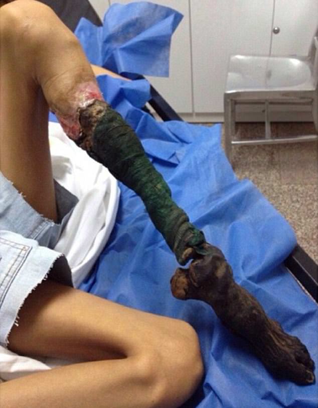 Zehirli yılan tarafından ısırılan bacak bu hale geldi