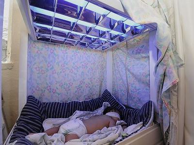 "Mavi Işık" hastası bebek tedaviye alındı