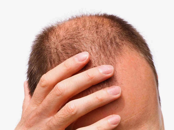 Saç dökülmesinin psikolojik etkileri - A Haber En Son Haberler