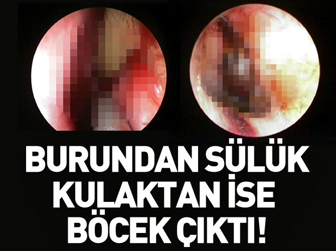 Burundan sülük kulaktan böcek çıktı!
