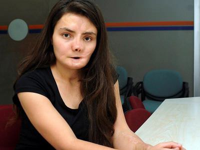 Çocuk gelin olmamak için yüzünü kaybetti
