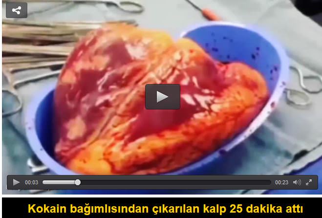 Kokain bağımlısından çıkarılan kalp 25 dakika attı
