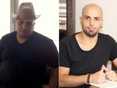 'Gastrik by-pass' ameliyatı ile 90 kilo verdi