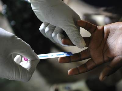 AIDS artık ölümcül değil