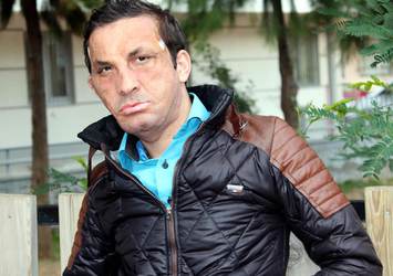 İlk yüz nakilli Uğur Acar, gripten hastanede