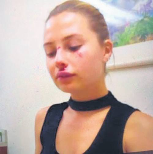 Chloe Loughnan kaldırımdan mı düştü, dayak mı yedi? - 1
