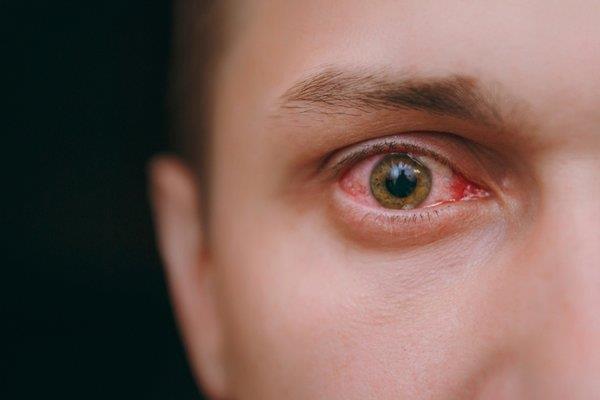 Adenovirüse dikkat! Hızla yayılıyor görme kaybına yol açabilir