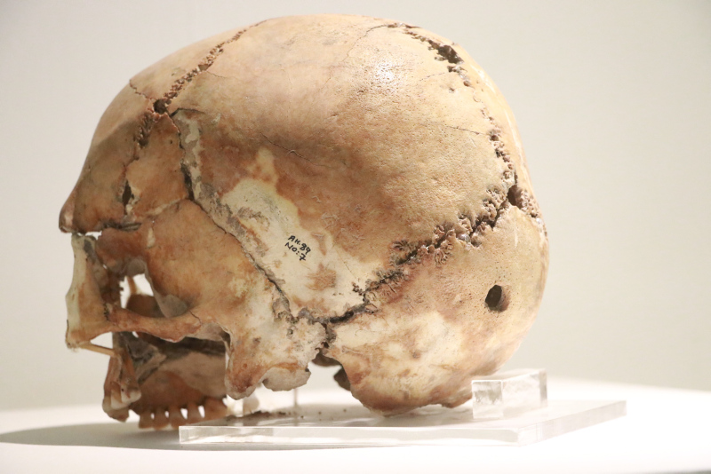 Dünyanın ilk beyin ameliyatı Aksarayda yapıldı! Tam 10 bin 500 yıllık