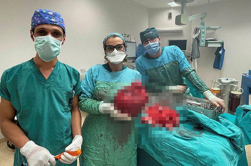 Doktorlar muayene edince ameliyata aldı! Karın ağrısı şikayetiyle gelen kadının midesinden çıktı