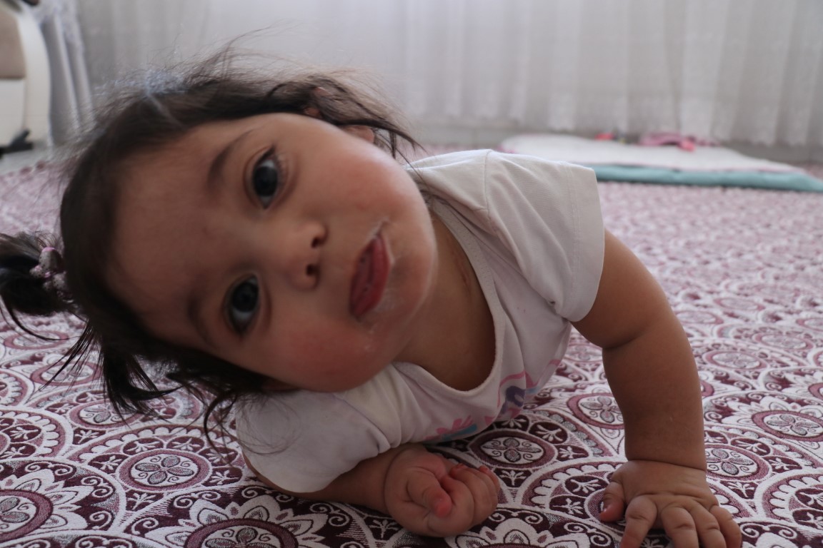 Gaziantep’te yemek borusu olmayan 1,5 yaşındaki Hiranur yutkunursa ölecek