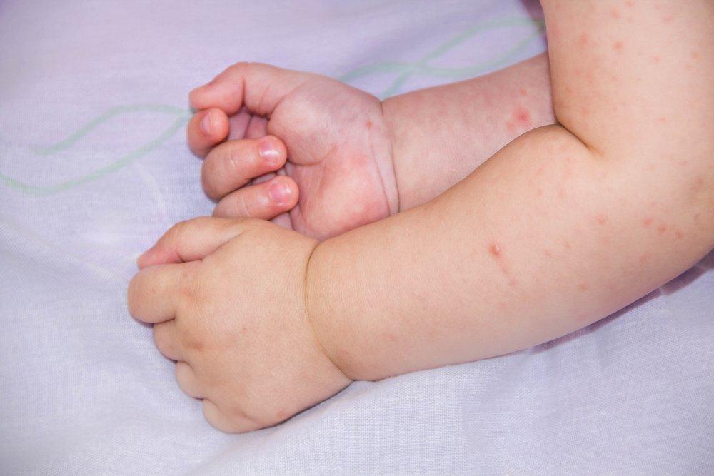 Bebeklerde atopik dermatite belirtileri nedir? Atopik dermatite karşı önlemler nelerdir?