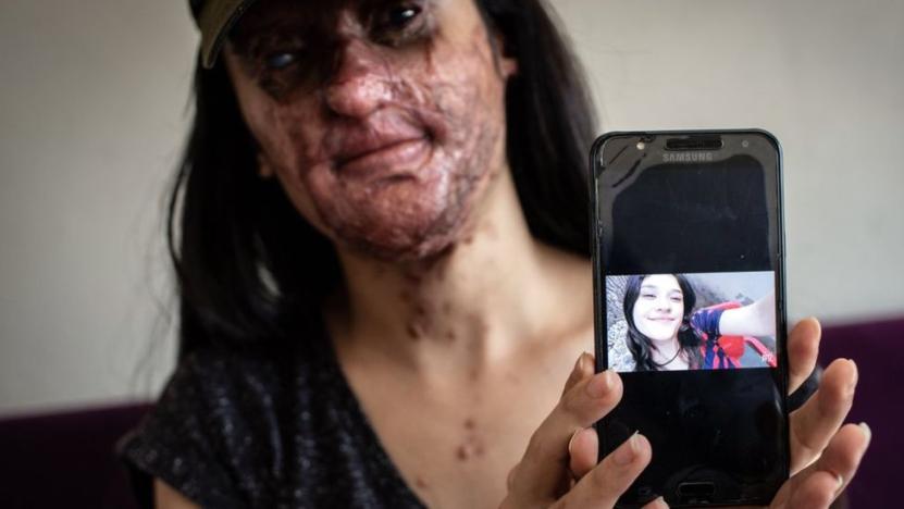 Asitli saldırıda yüzü yanan Berfin, 12 saat süren zorlu ameliyattan çıktı