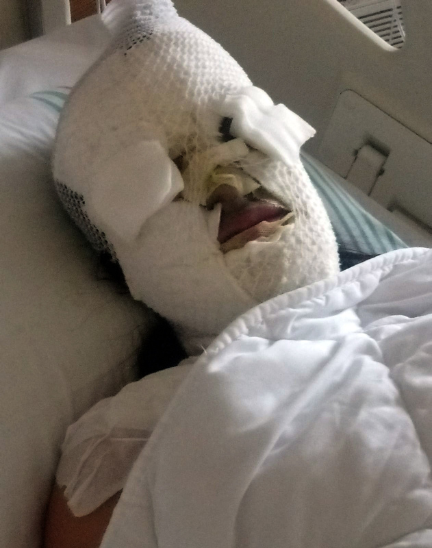 Asitli saldırıda yüzü yanan Berfin, 12 saat süren zorlu ameliyattan çıktı