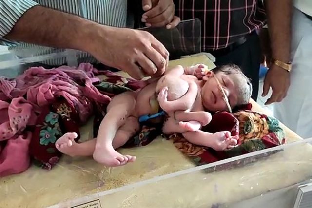 Hindistan’da şoke eden doğum! Kadın, dört bacaklı ve üç kollu kız çocuğu doğurdu