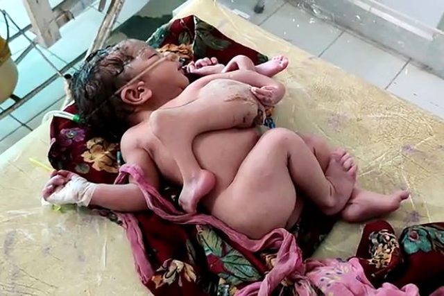 Hindistan’da şoke eden doğum! Kadın, dört bacaklı ve üç kollu kız çocuğu doğurdu
