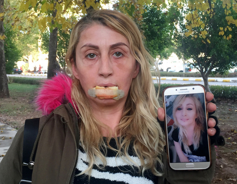 Antalya’da dolgu yapılan dudağını kaybeden Songül, artık yemek yiyebiliyor