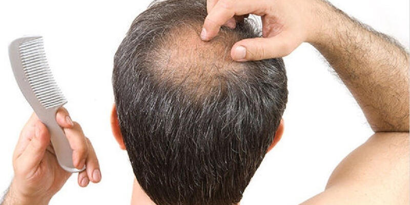 Saç dökülmesini bir gün içinde durduruyor!