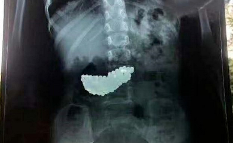 Röntgenle tespit edildi: 5 yaşındaki çocuk 2 ay böyle yaşadı!
