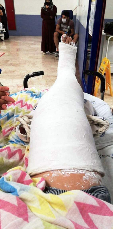 İzmir’de feci olay! Mazgal kapağı yüzünden bacağı kırıldı
