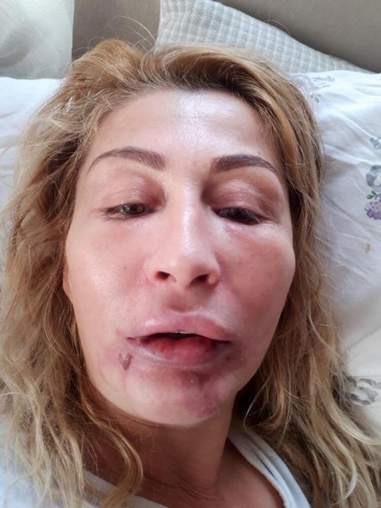 Estetik ameliyat sonrası dudağı çürüyen Songül Uzunoğlu doğal görünümüne kavuşacak