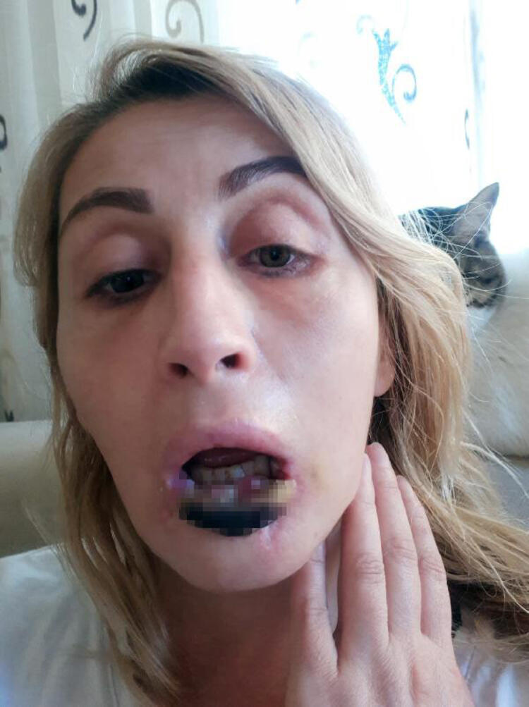 Estetik ameliyat sonrası dudağı çürüyen Songül Uzunoğlu doğal görünümüne kavuşacak