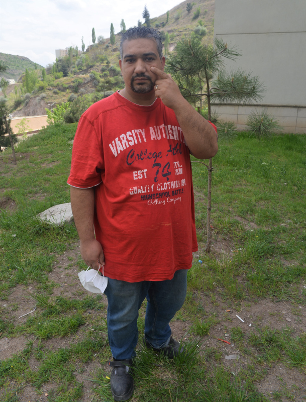 Ankara’da yüzüne mıknatıs tutan vatandaş gözündeki metali fark etti