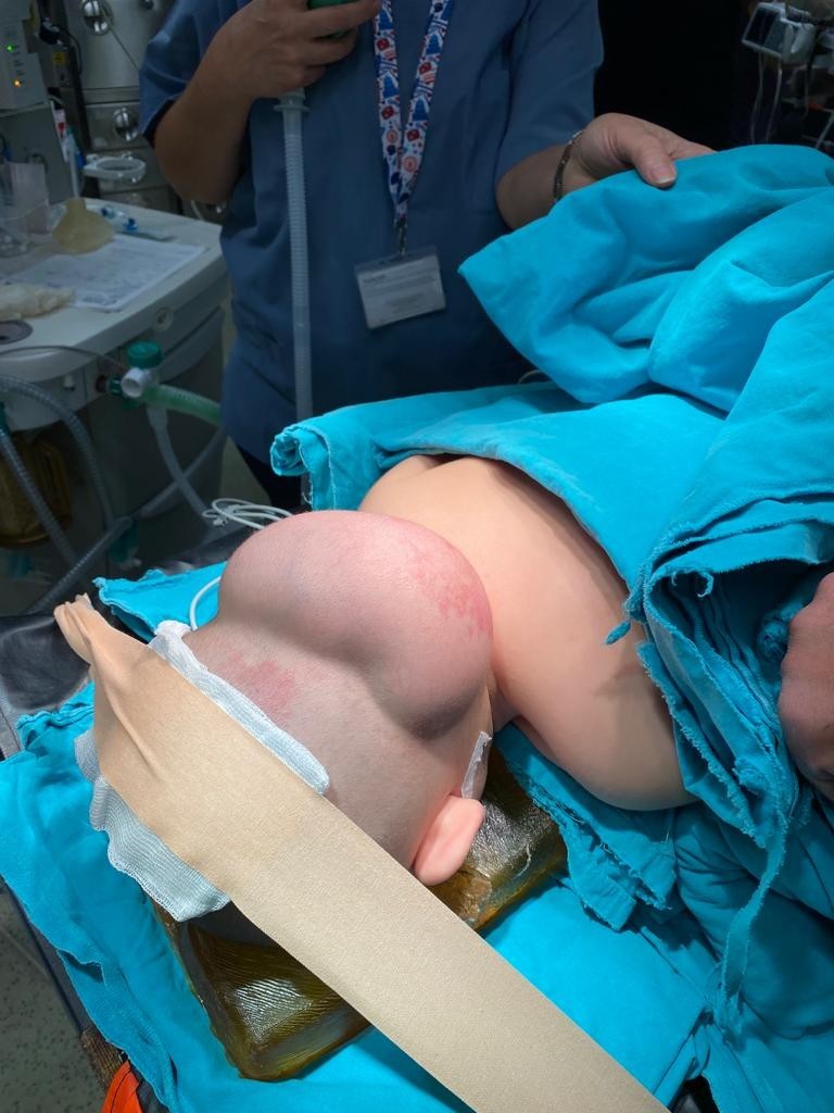 Manisa’dan şoke eden haber! 10 aylık bebeğin ensesinden 14 santimetrelik tümör çıkarıldı