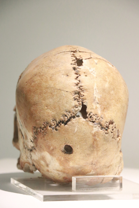 Dünyanın ilk beyin ameliyatı Aksaray’da yapıldı! Tam 10 bin 500 yıllık