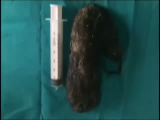 Midesinden 850 gram saç çıktı