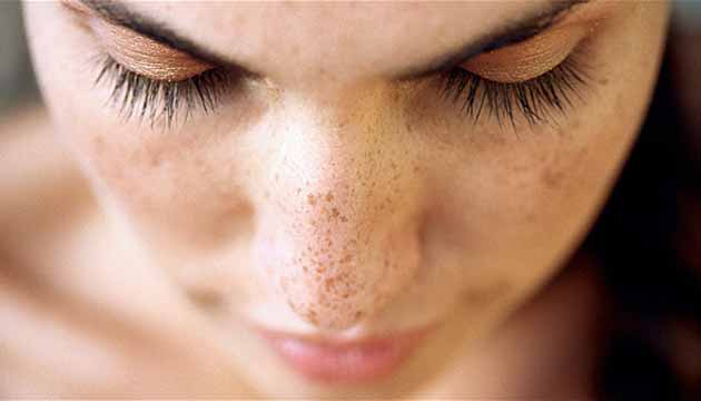Vücudunda güneş lekesi olanlar dikkat! İşte alternatif tedavi yöntemleri