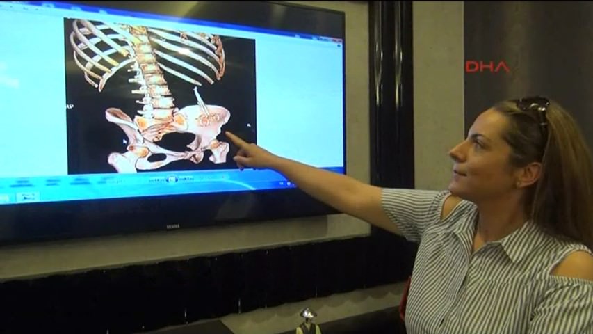 Karnında makas unutuldu